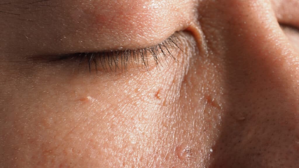 Macro shot of warts near eye on face papilloma on skin around eye skin care 1160446